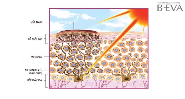tia UV trong ánh nắng mặt trời cũng khiến các hắc sắc tố melanin trên da phát triển mạnh hơn,